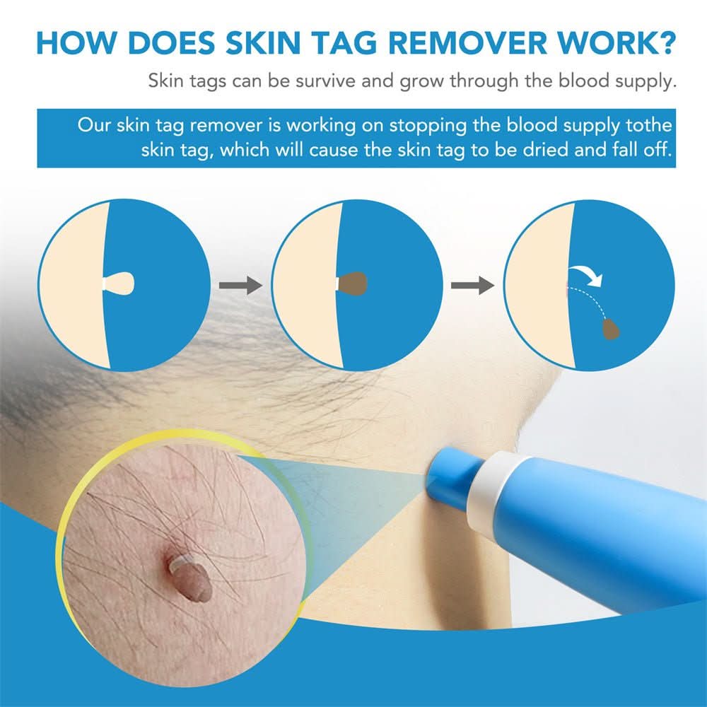 Dermaswift – Hautflecken entfernen gegen Warzen und Hautwucherungen