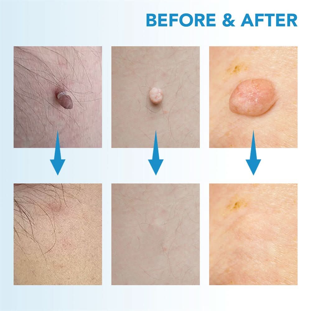 Dermaswift – Hautflecken entfernen gegen Warzen und Hautwucherungen
