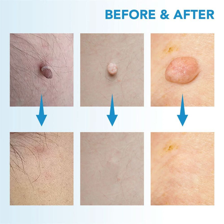 Dermaswift – Hautflecken entfernen gegen Warzen und Hautwucherungen